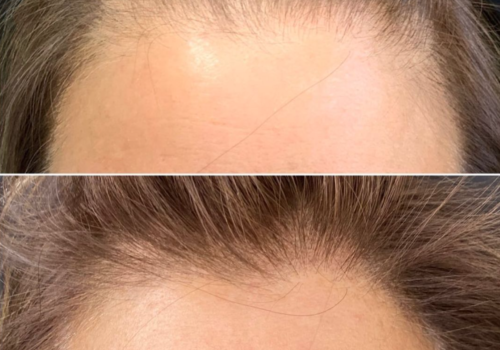SCALP MICRO-PIGMENTATION BEFORE & AFTER